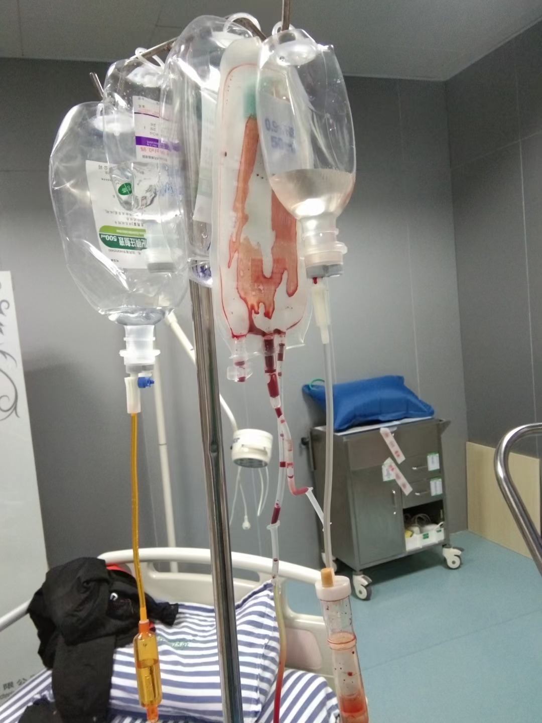 舌癌病例分享,舌癌吐血