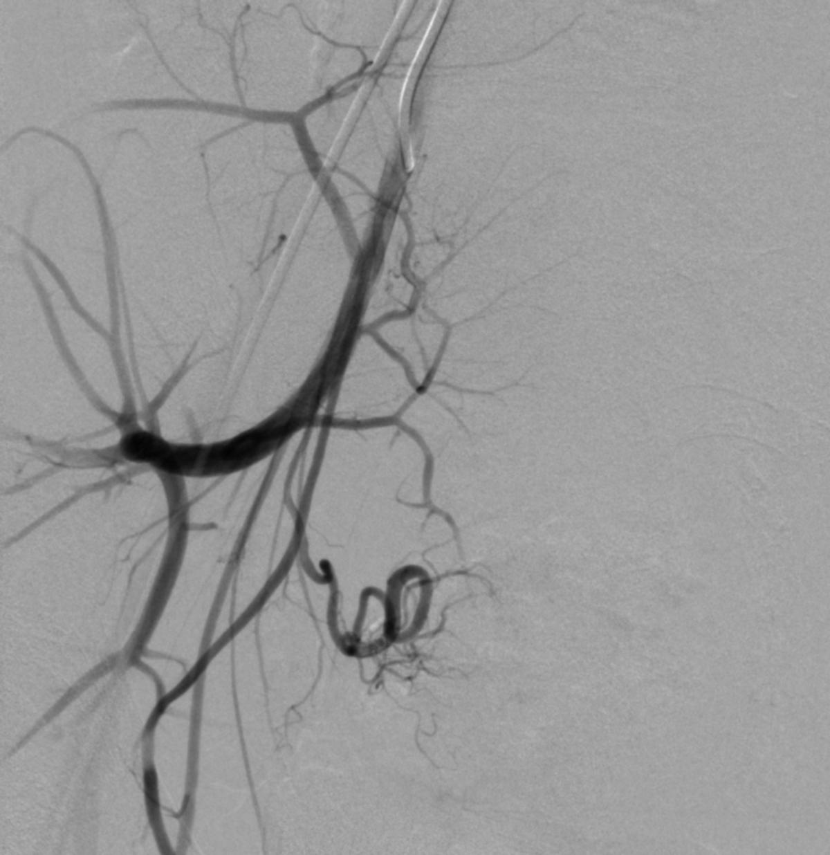 14岁女孩非经期出血,14岁女孩非月经期出血是怎么回事