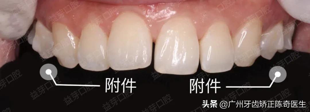 附着在牙齿上面硬硬的东西是什么,牙齿连接处有小疙瘩