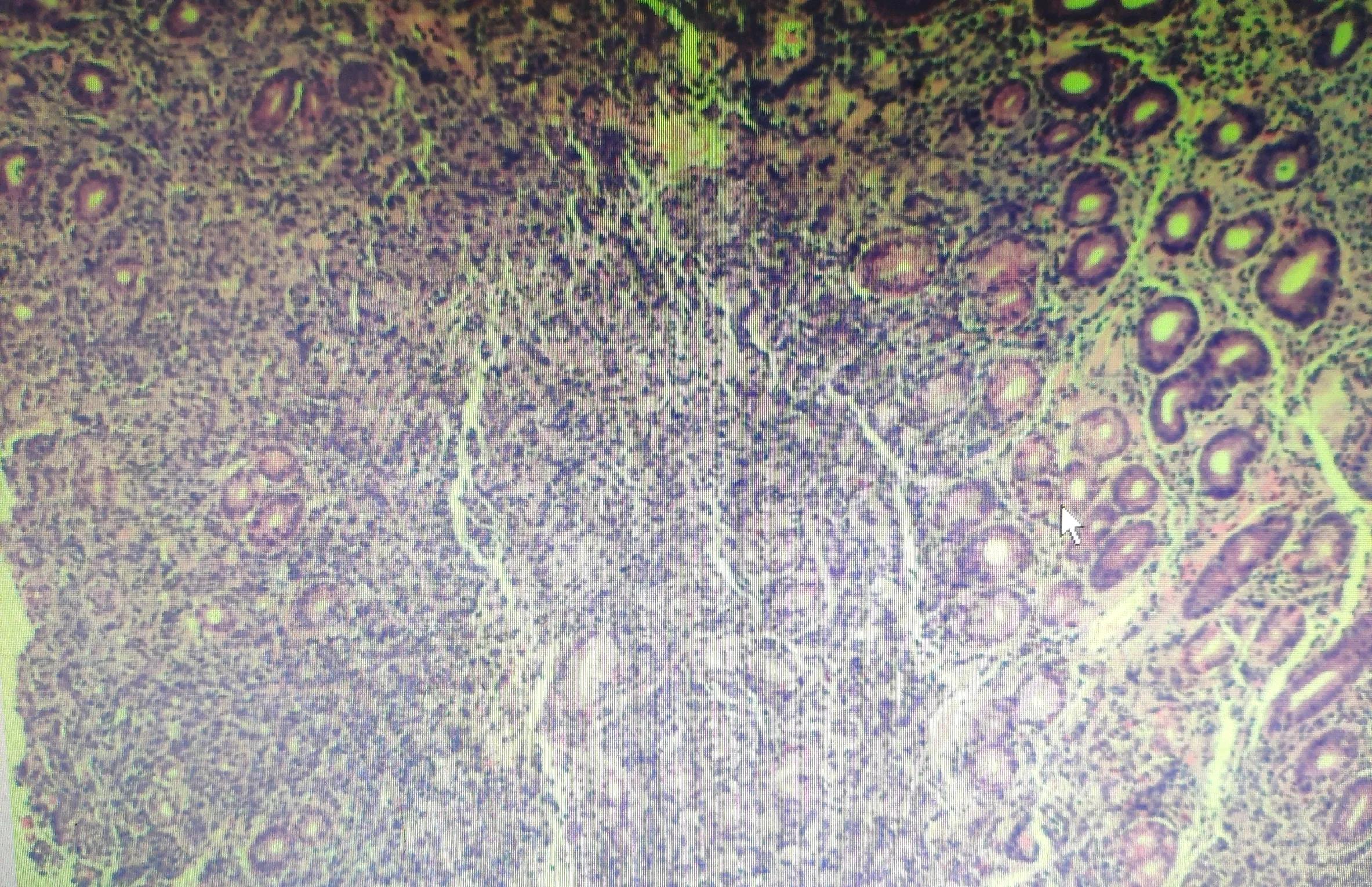 胃体隆起严重吗会癌变吗,胃窦溃疡周围隆起都是癌吗