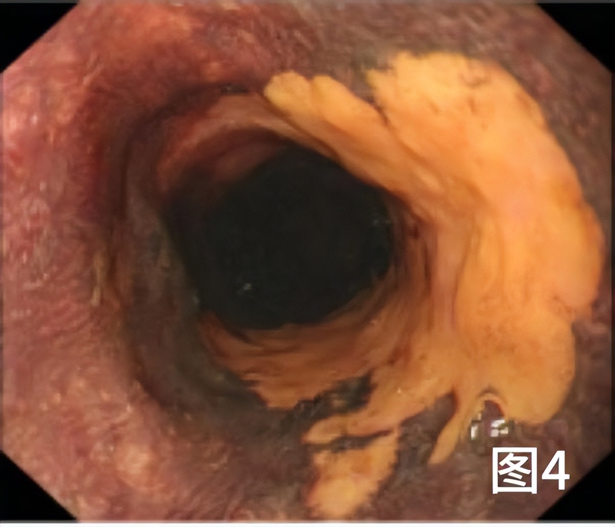 病例档案纪录片,食管早期癌的内镜筛查