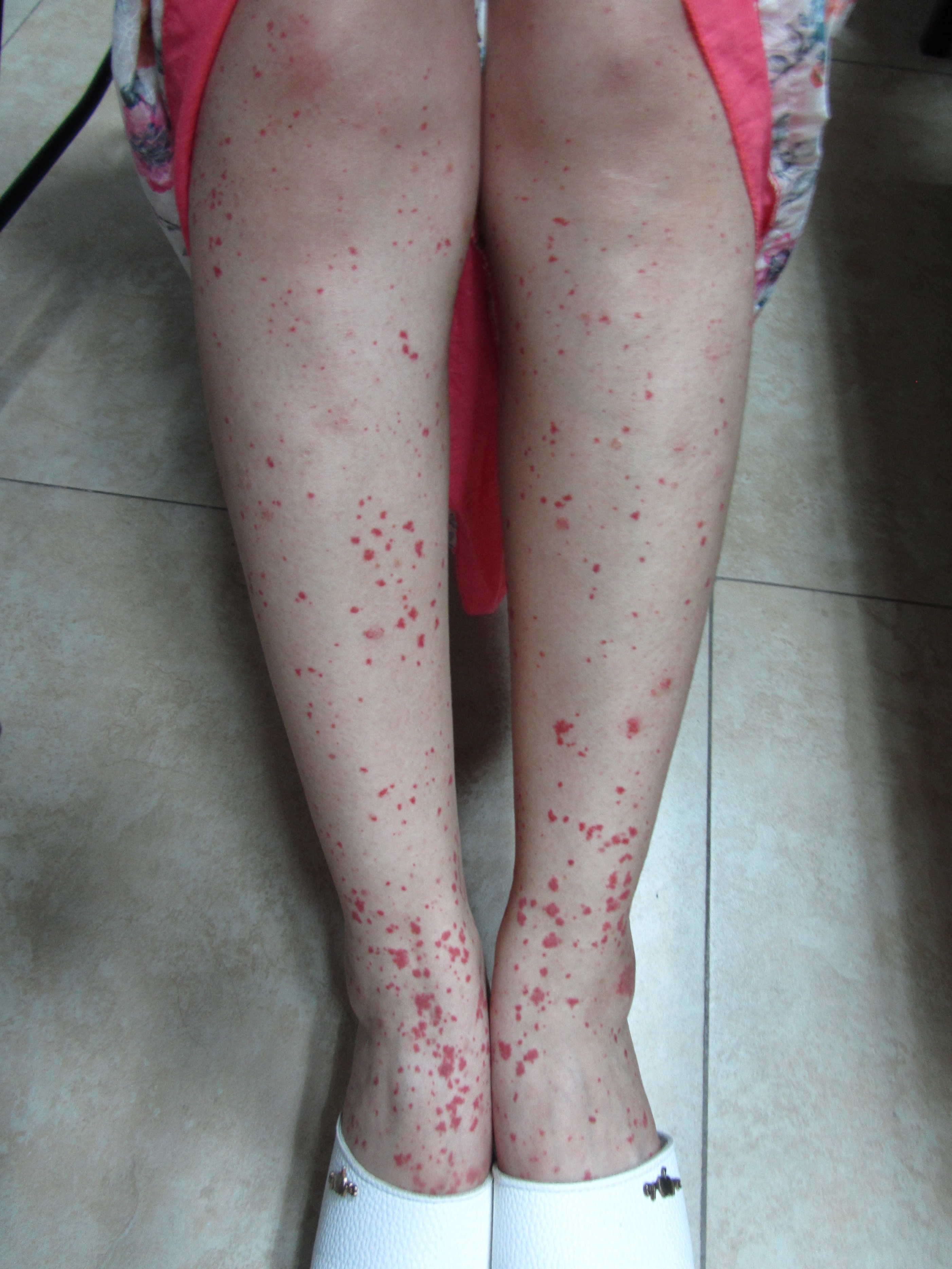 手上有红色的小点点过敏性紫癜,腿上有小红点皮下出血