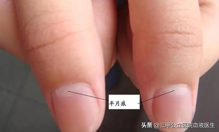 手指甲出现横纹预示身体怎样,手指甲有凹凸竖纹正常生理现象
