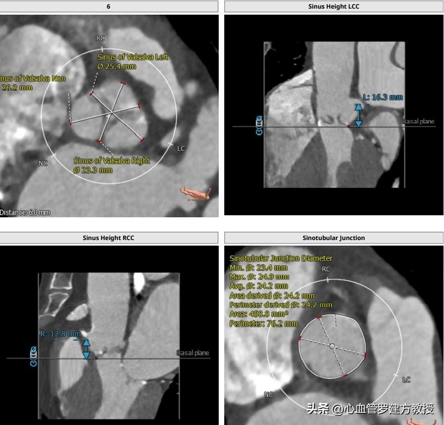主动脉瓣狭窄的典型三联征表现,主动脉瓣狭窄治疗新技术