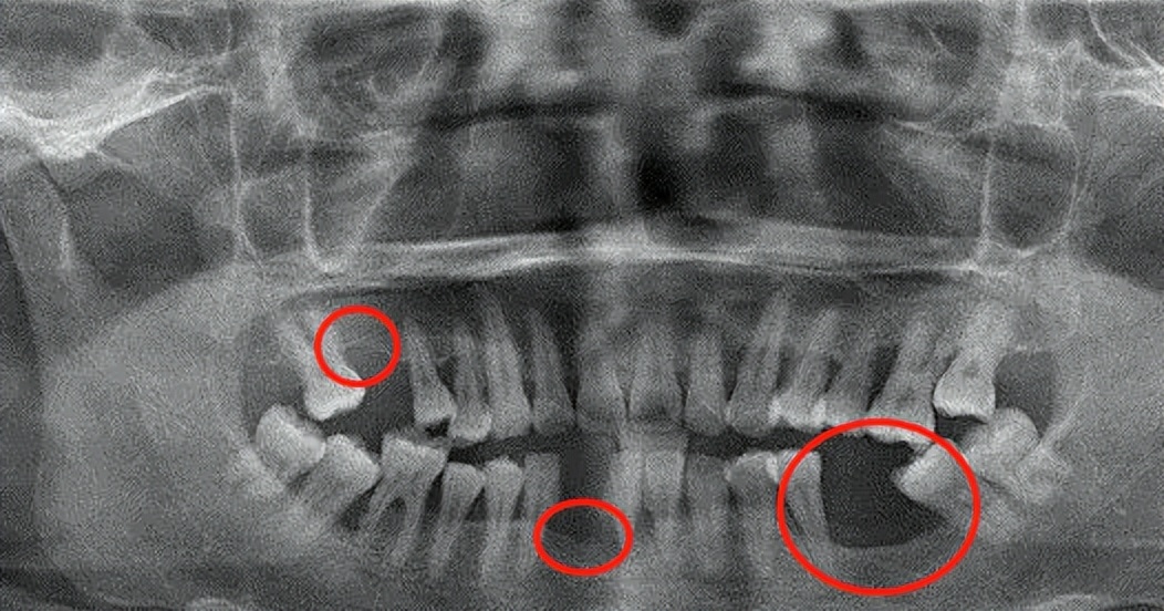 缺牙后，如何防止牙槽骨吸收？专家给出3个有效办法