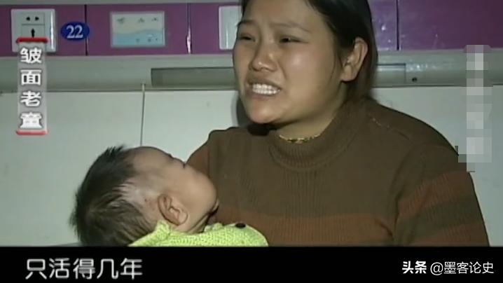 故事:河南1岁女婴患早老症,一夜变成80岁老人,母亲含泪千里求医