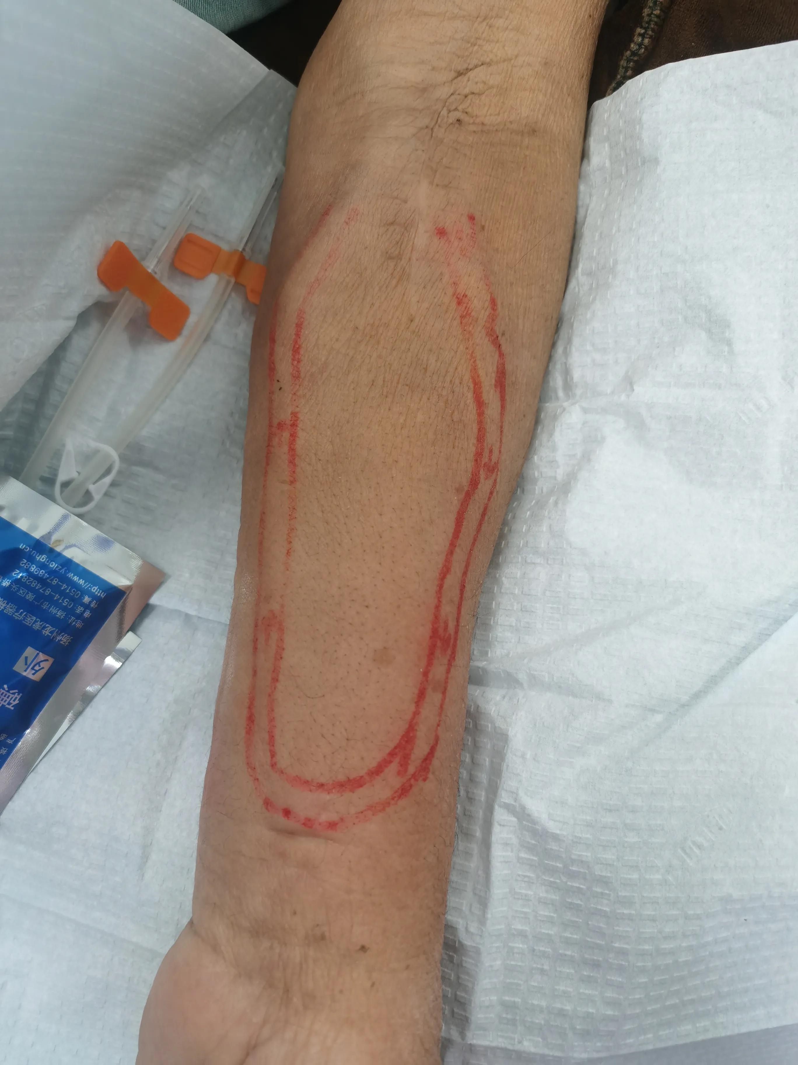 血管通路维护的意义,血管通路护理是怎样工作的