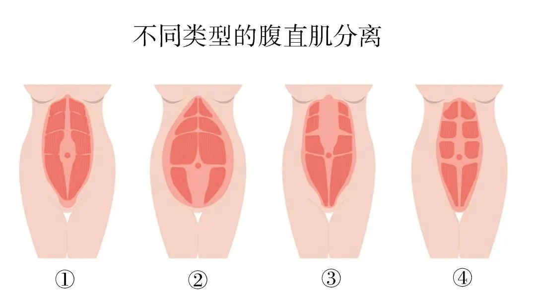 腹直肌分离怎么激活腹肌,腹肌腹直肌分离的讲解