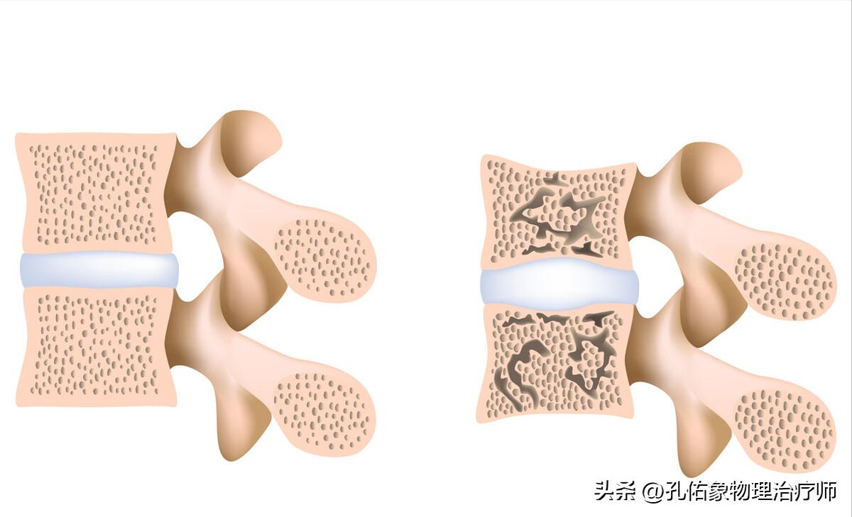 老年人腰部压缩性骨折怎么治疗,腰部压缩骨折多久才能恢复