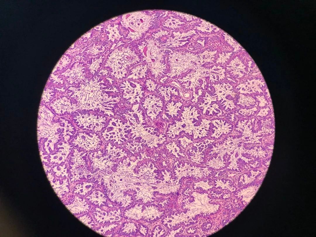 医生说病理报告有点小问题,病理报告没出来好害怕啊