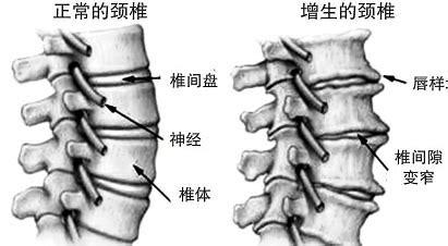 骨刺骨质增生挂什么科,骨刺骨质增生图片大全