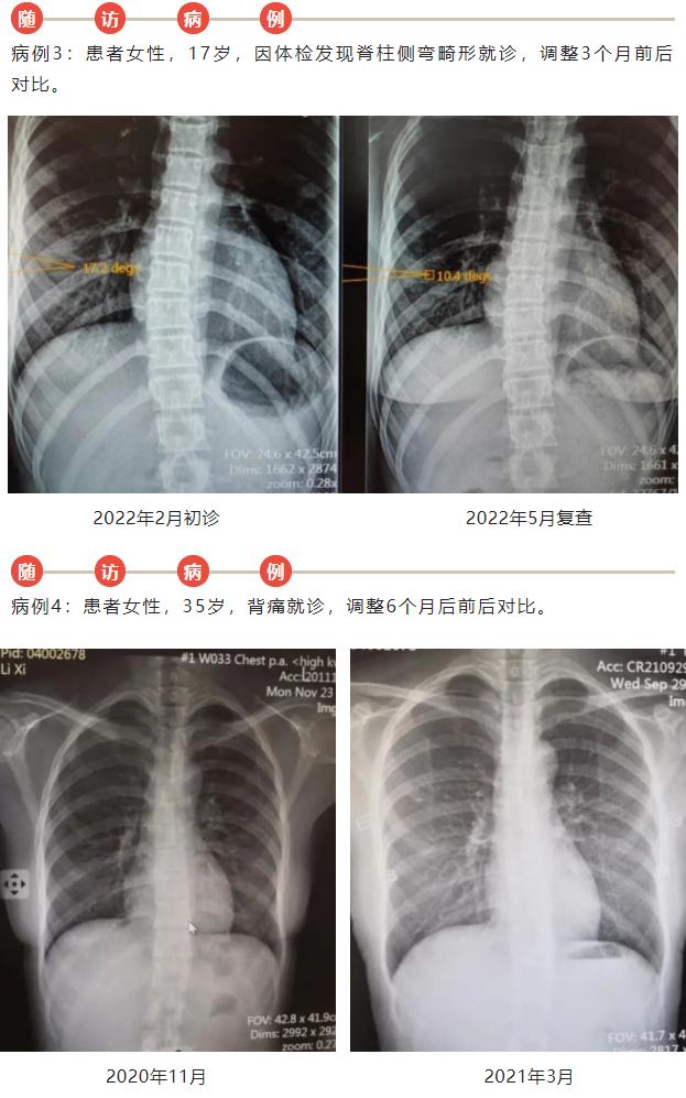 脊柱侧弯站立矫正法,脊柱侧弯自我矫正法站桩