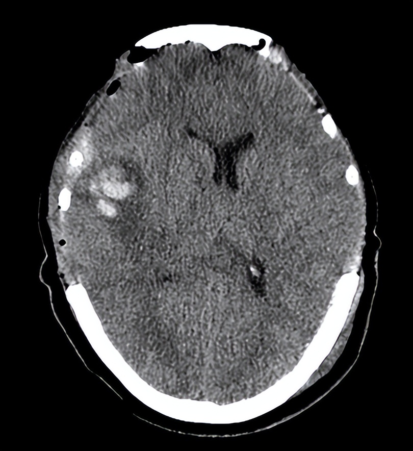 医院成功救治重型颅脑患者,特重型颅脑损伤治愈案