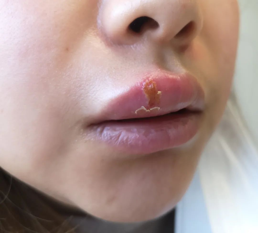 口唇边疱疹最好的治疗方法,口周疱疹