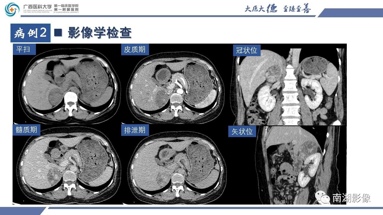 肾上腺海绵状血管瘤,肾上腺血管瘤是良性还是恶性