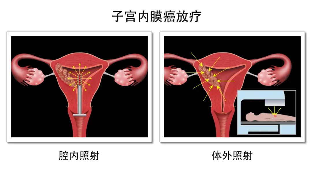 子宫内膜癌化疗后出血怎么回事,子宫内膜癌和宫颈癌出血的区别