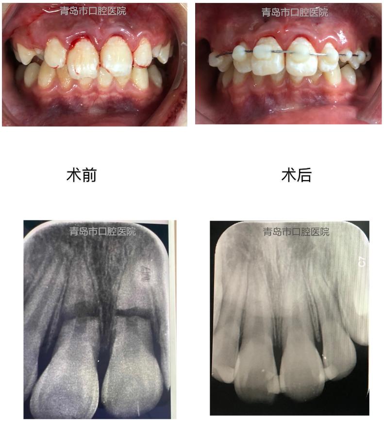 小孩门牙磕断了一个角,十岁孩子磕断门牙怎么办