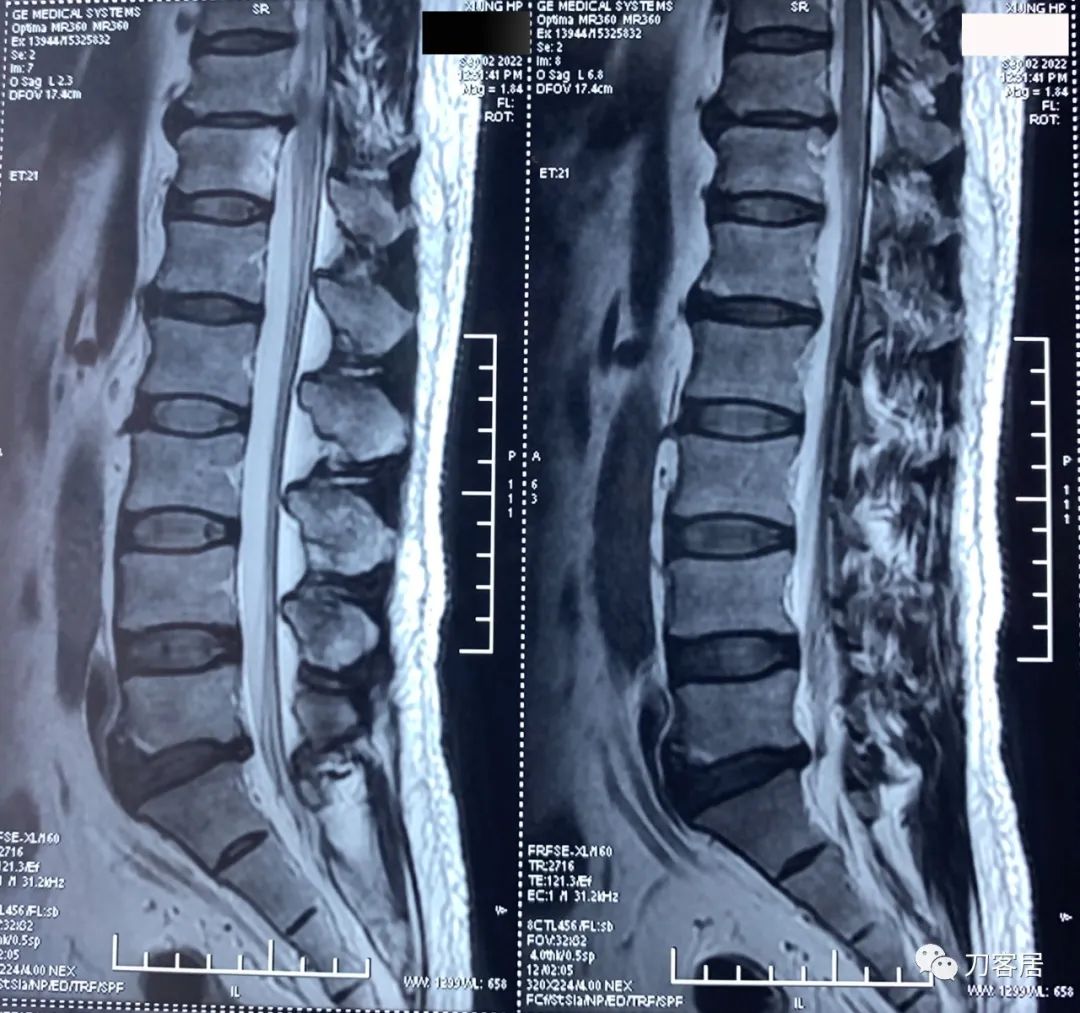 良性单侧下肢肌萎缩,下肢肌肉萎缩24年能治好吗