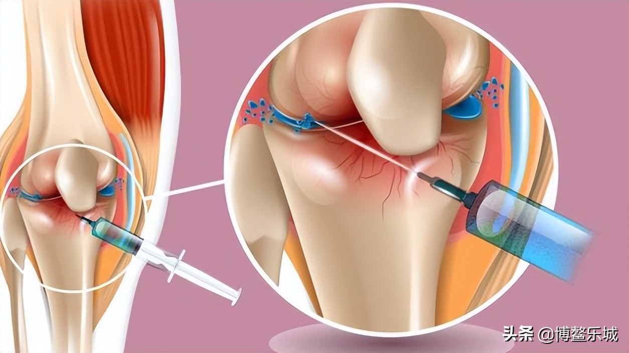无需手术，乐城颖奕PRP注射治疗让深受膝关节炎苦痛多年的患者告别了轮椅……