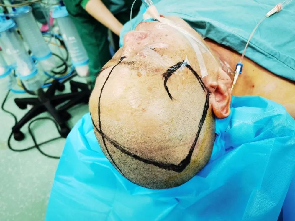 动脉瘤蛛网膜下腔出血术后并发症,动脉瘤导致蛛网膜下腔出血严重吗