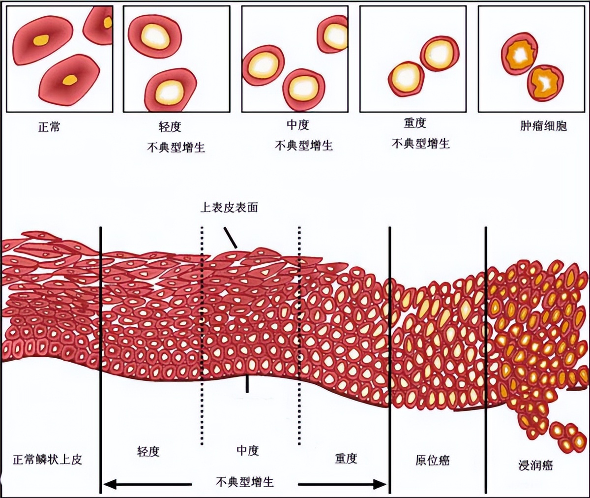 派特灵生物科普｜宫颈低级别上皮内瘤变4大要点