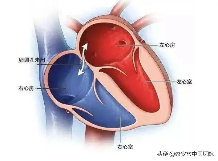 无症状核磁共振诊断脑梗,不明原因头疼需要做脑血管造影吗