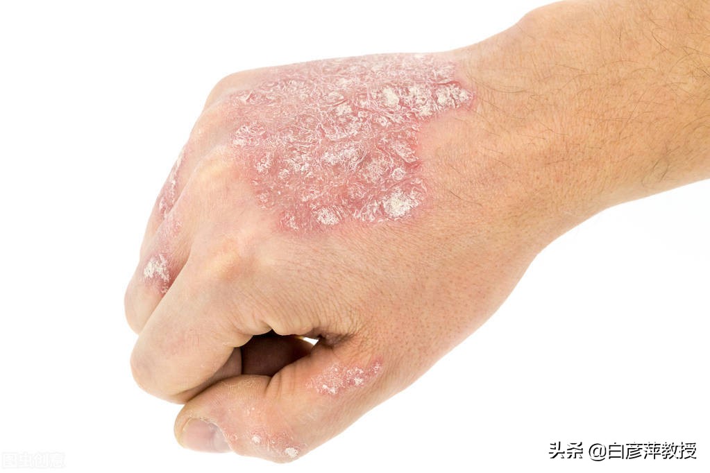 刘红云针灸治疗银屑病,针灸治银屑病医生推荐