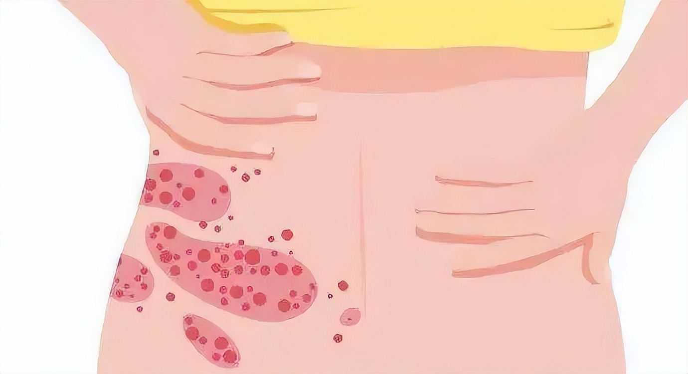 又痒又痛的皮肤病是什么病,饱受皮肤病折磨太煎熬了