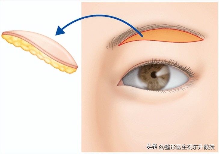 提眉手术需要提几层效果好,提眉最多一生能做几次提眉