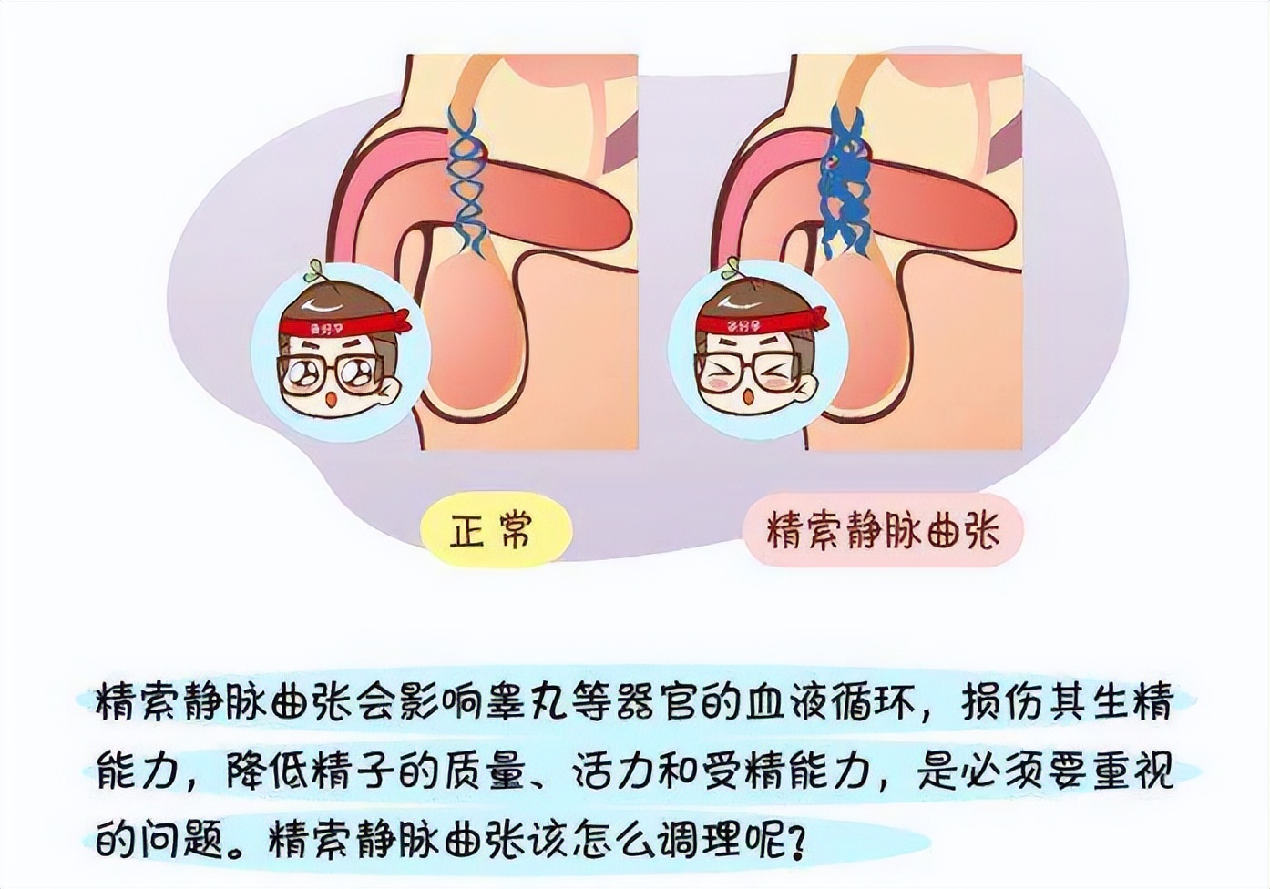男性不育的诱因精索静脉曲张,男性不育静脉曲张有什么症状