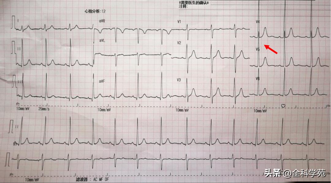 心电图笔记26：QRS波振幅变高，需要想到哪些