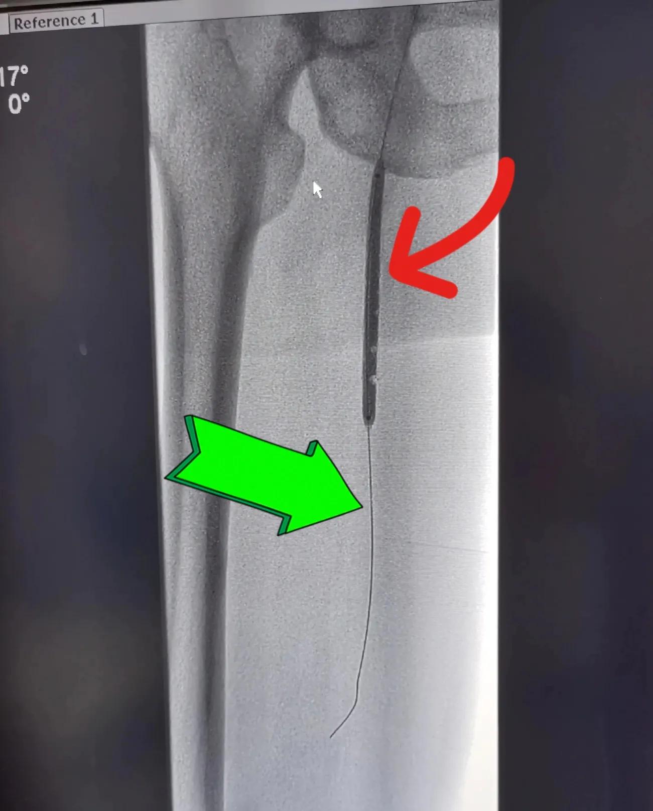县级医院介入治疗下肢动脉硬化闭塞症