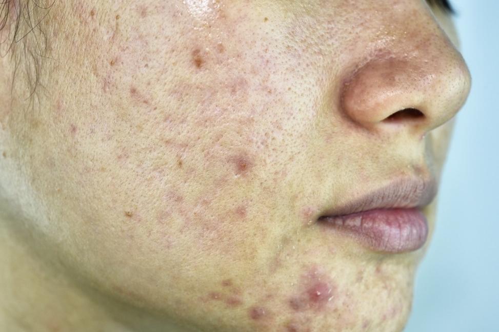 为啥斑点痘印难消,痘印瑕疵怎么办