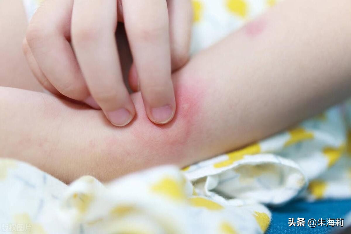 湿疹有哪些危害,皮肤科相关知识湿疹