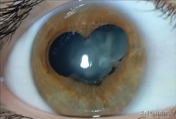 瞳孔三角形后遗症,瞳孔变成三角形是什么原因