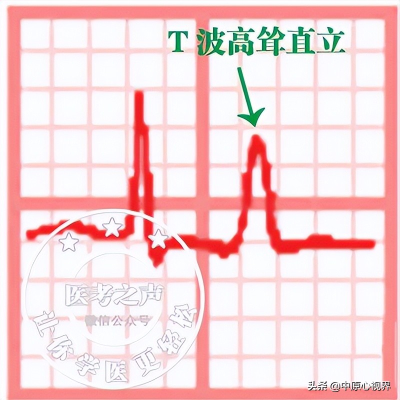 护考几种常见的心电图,常见的心电图图形分析
