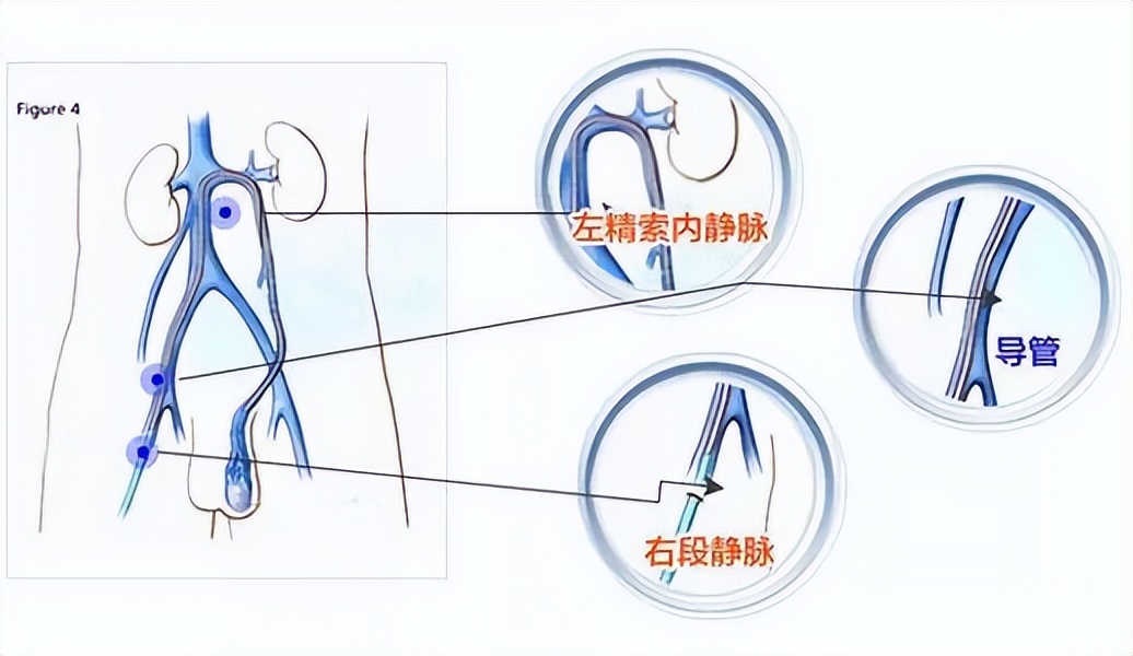 左侧精索静脉曲张呈蜂窝状严重吗,精索静脉曲张手术后团块能消失吗