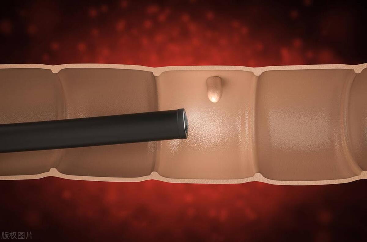 少年腹痛一年查出巨瘤,年轻小伙腹痛去医院