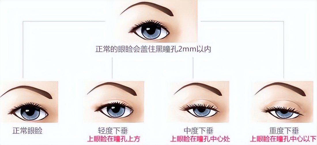 儿童上睑下垂怎么矫正,有什么方法可以帮助孩子上睑下垂