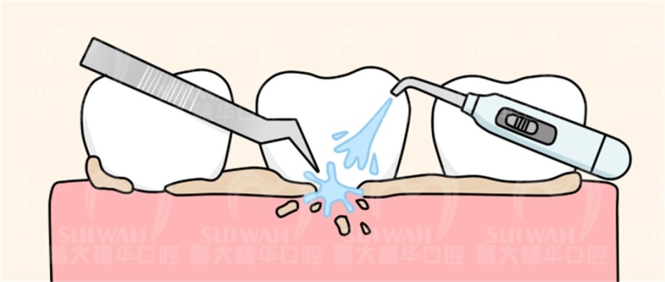 牙齿缝隙越来越大是怎么回事,45岁牙齿缝隙越来越大能矫正吗