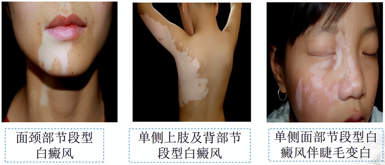 皮肤色素减退和白癜风有什么区别,白癜风是不是色素性皮肤病
