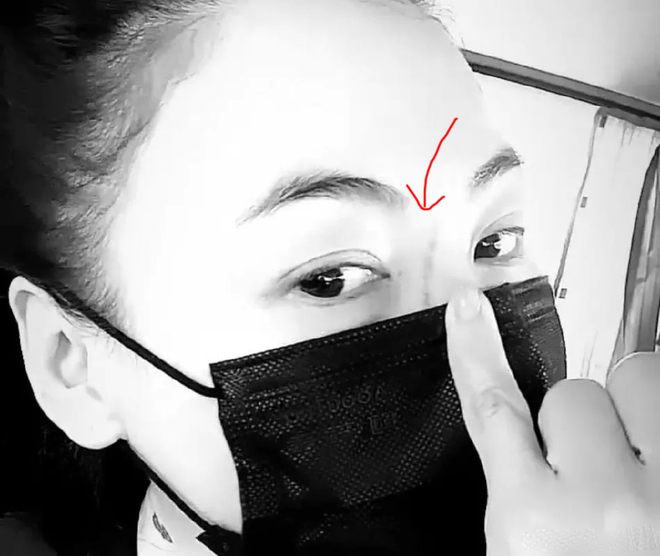 张柏芝晒出怼脸自拍，自曝鼻梁被3岁小儿子抓伤，超长伤疤很明显