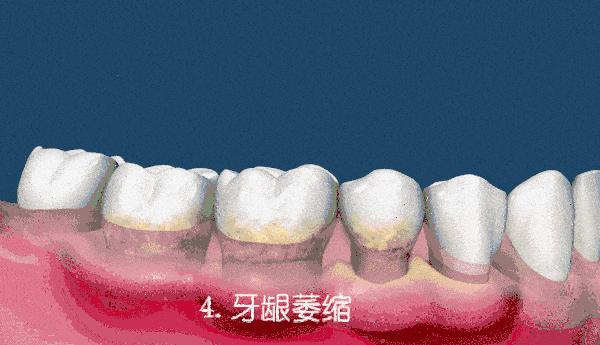 老年人大牙稀疏牙缝大怎么整,牙齿稀疏牙缝大怎么矫正老人