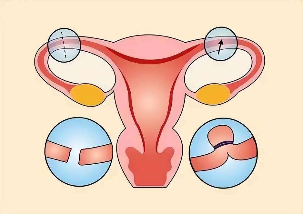 男人结扎跟女人结扎的利弊,男人结扎和女人结扎的区别是什么