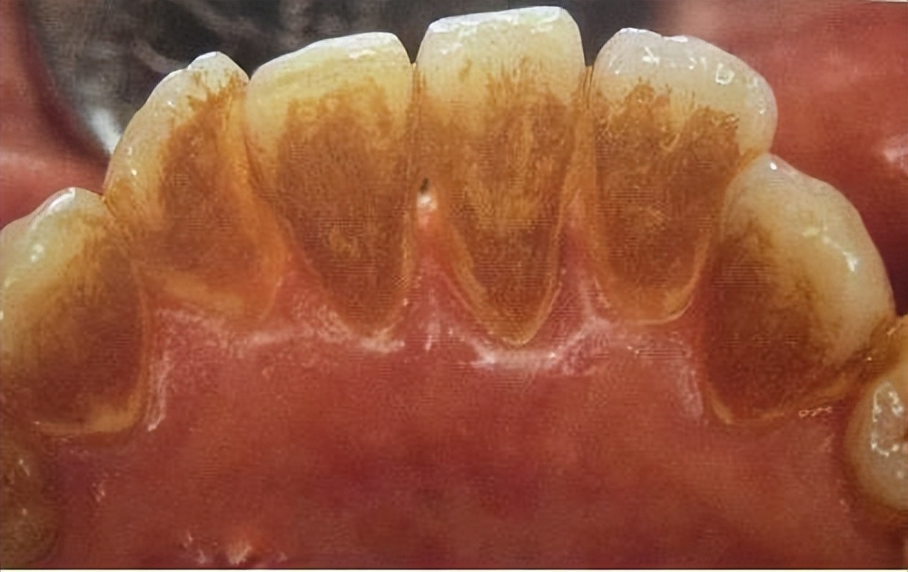 牙结石能直接抠下来吗,牙结石用手可以抠掉吗