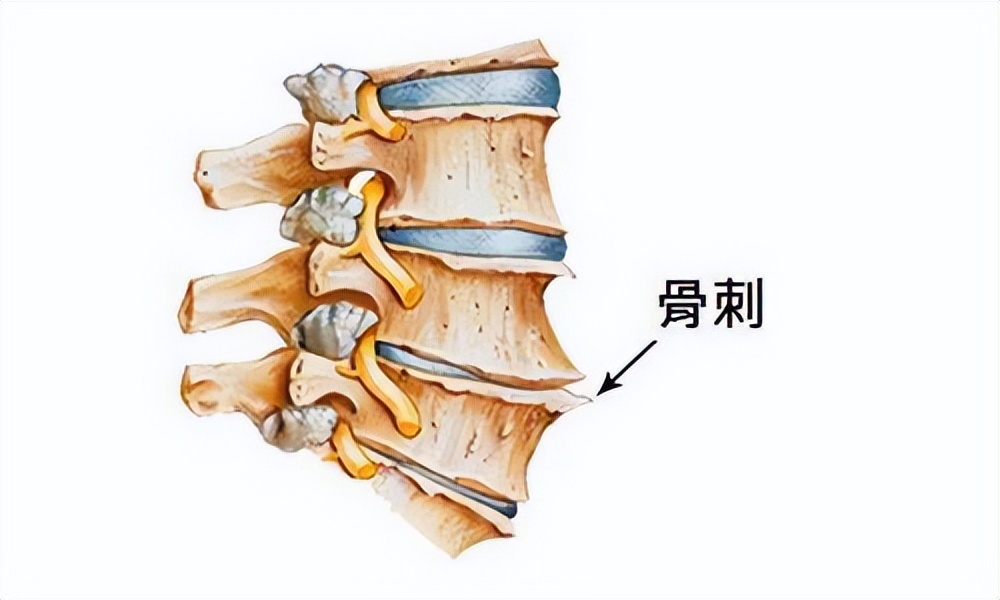 什么叫做骨刺骨刺都长在什么地方,什么是骨刺能根治吗