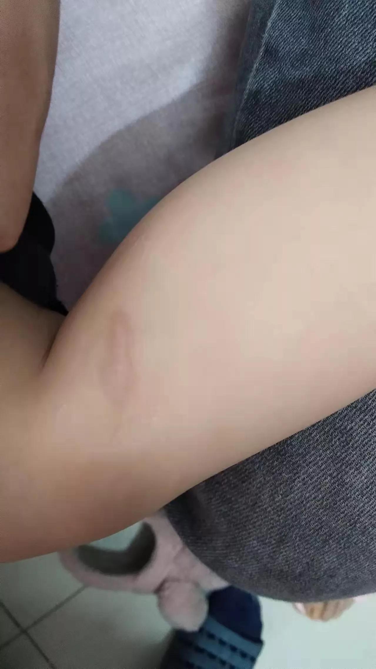 小孩被开水烫后，错误案例及正确处理方法