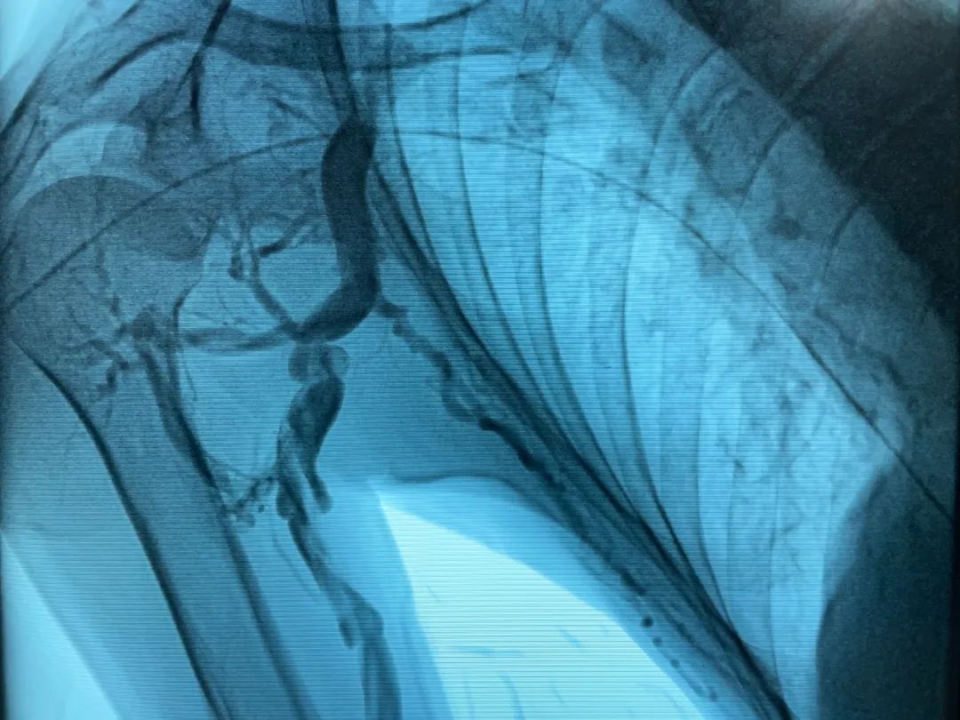 透析患者静脉瓣增生狭窄肾内科血管腔内治疗解决烦恼