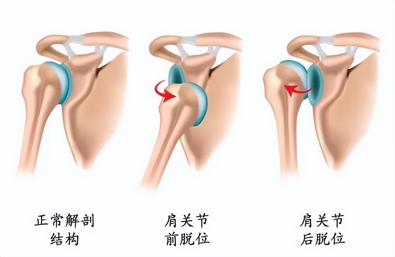 为什么肩关节易向前下方脱位,肩关节为什么容易脱臼