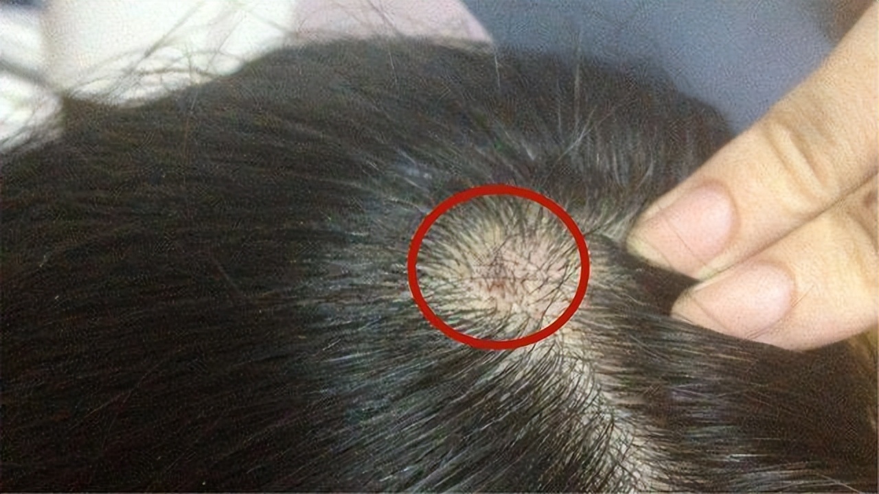 头皮上长红疙瘩脓包头皮屑特别多,头皮总是长疙瘩或脓包是什么原因